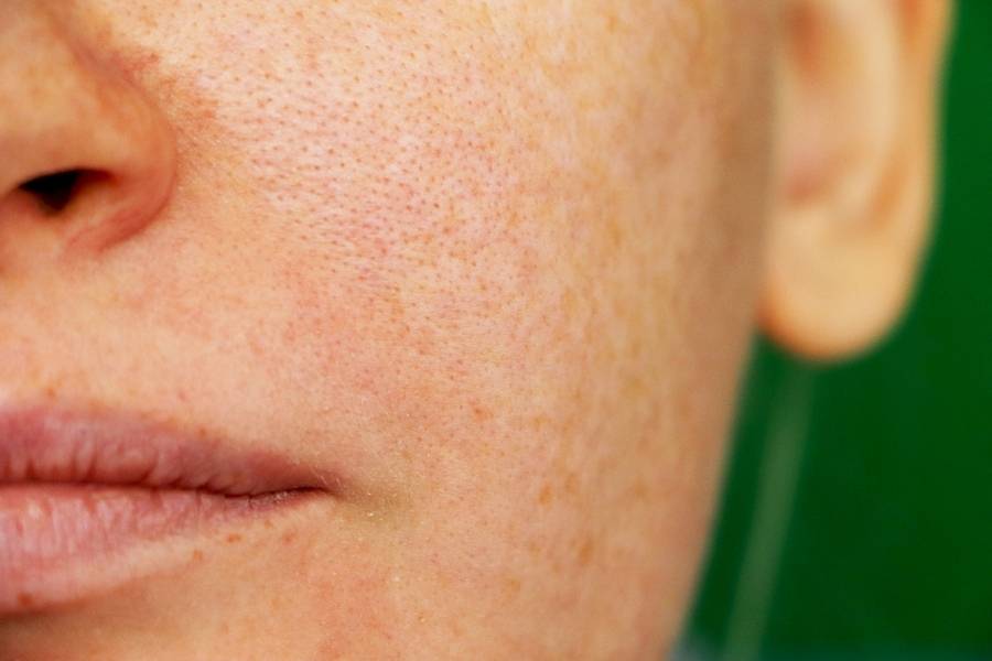 natural treatments for large pores