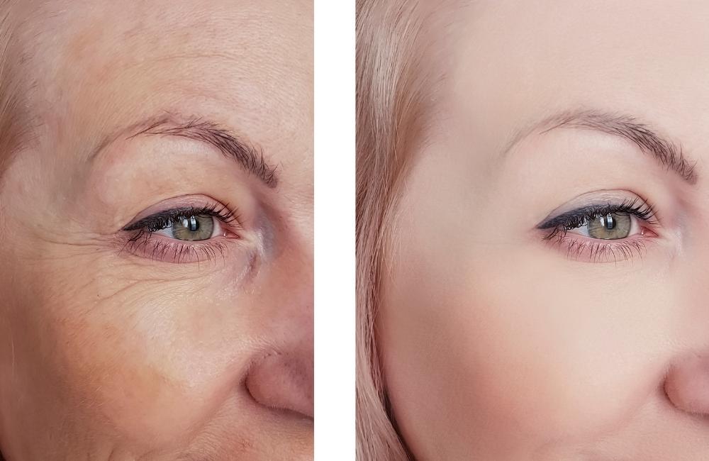 under eye wrinkles natural treatment