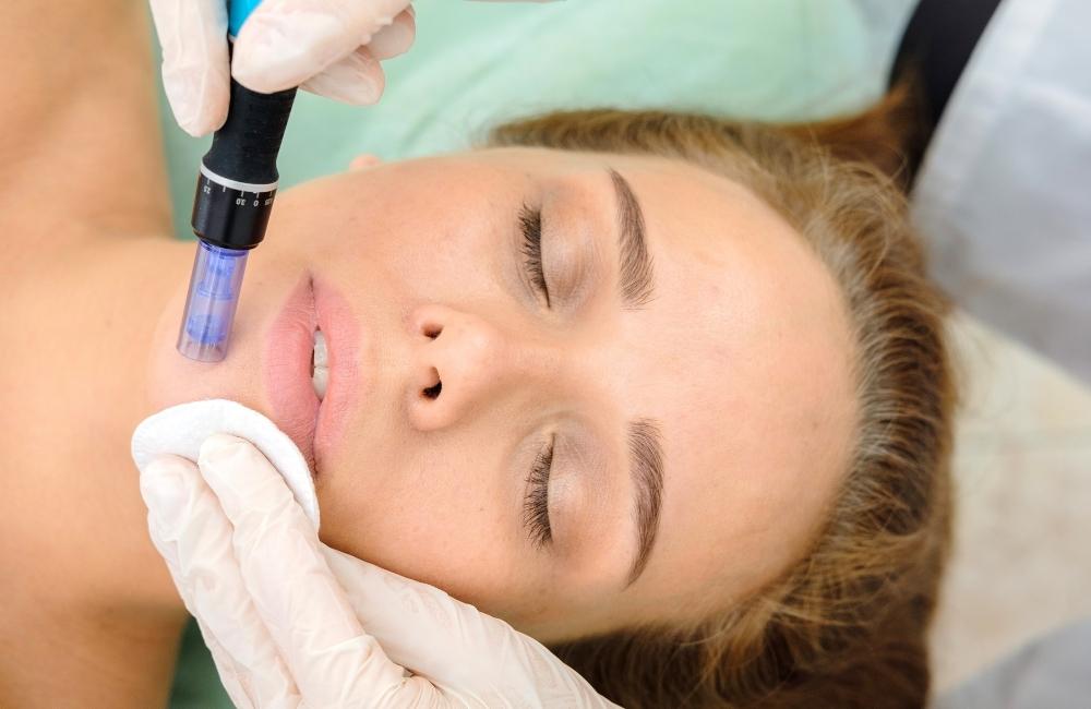 microneedling side effects