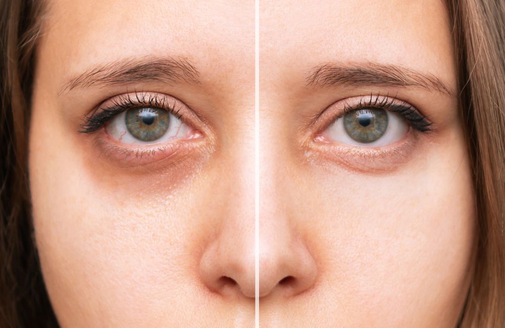 minimally invasive treatments for dark circles